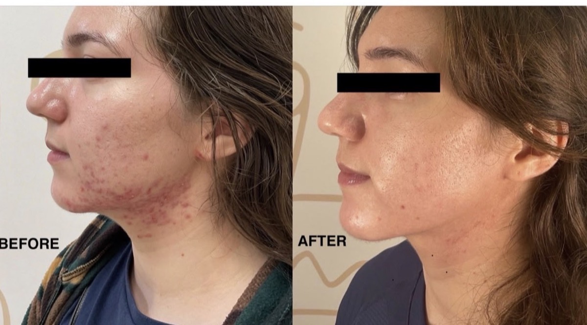 Before and after acne treatment along the jawline in Newport Beach, CA