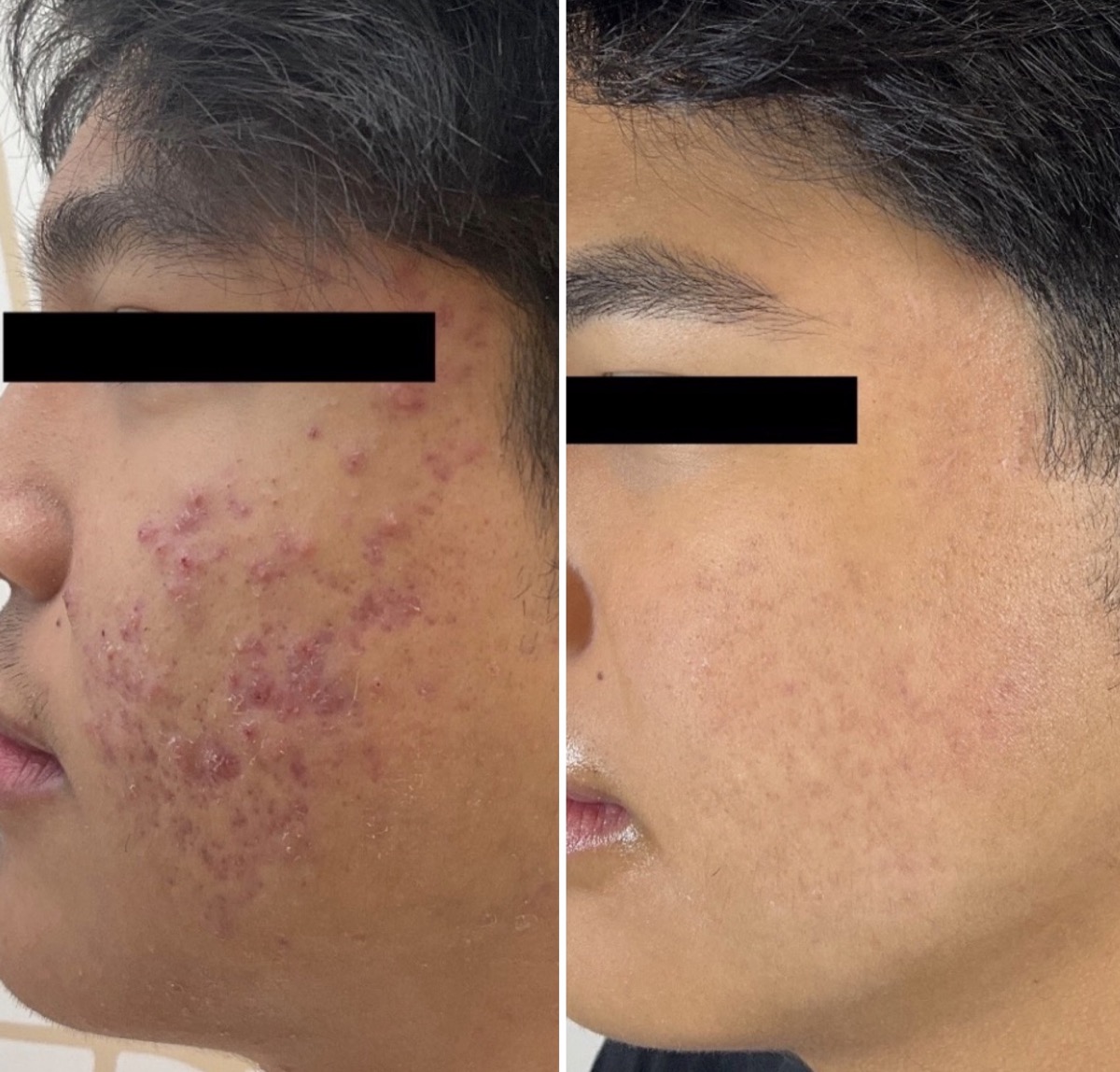 Before and after acne treatment on the cheek in Newport Beach, CA