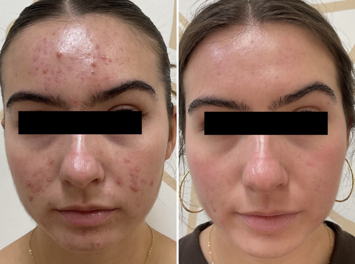 Before and after acne treatment on the forehead and cheeks in Newport Beach, CA