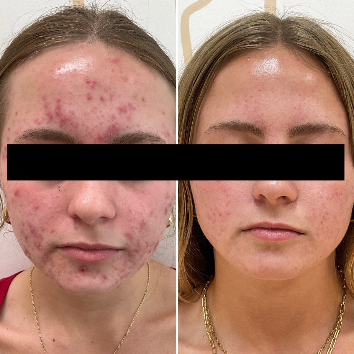 Before and after treatment of inflamed facial acne in Newport Beach, CA
