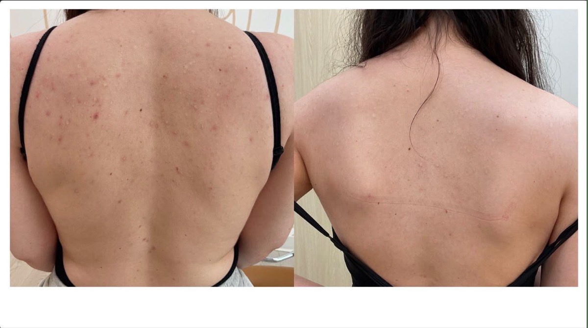 Before and after acne treatment on the upper back in Newport Beach, CA