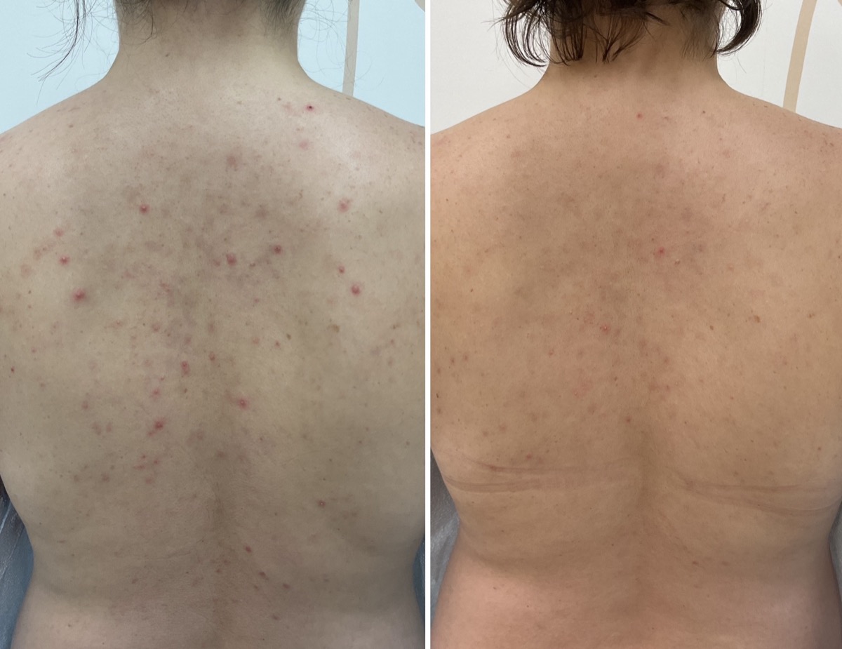 Before and after back acne treatment in Newport Beach, CA