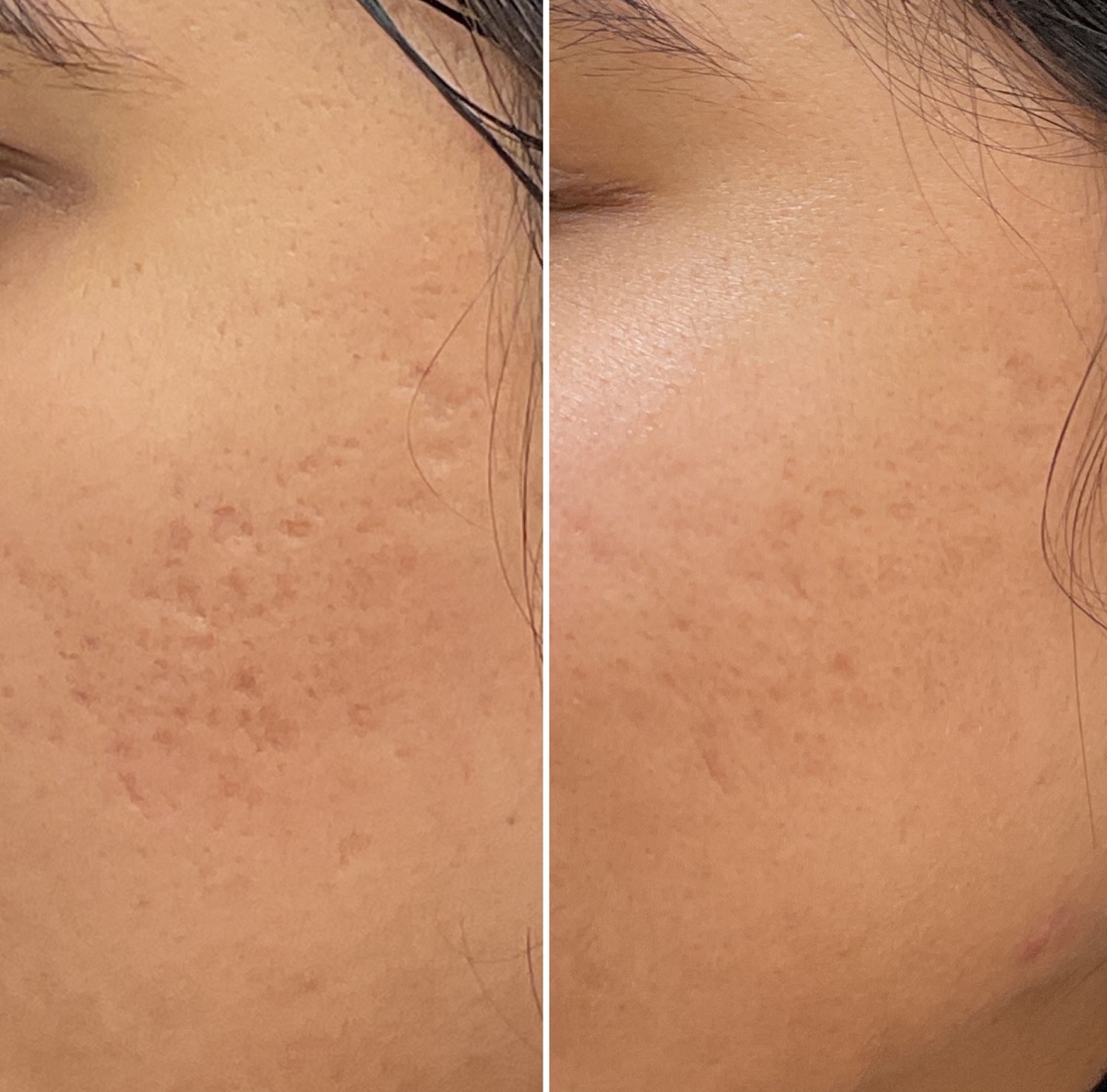Before and after acne scar treatment in Newport Beach, CA