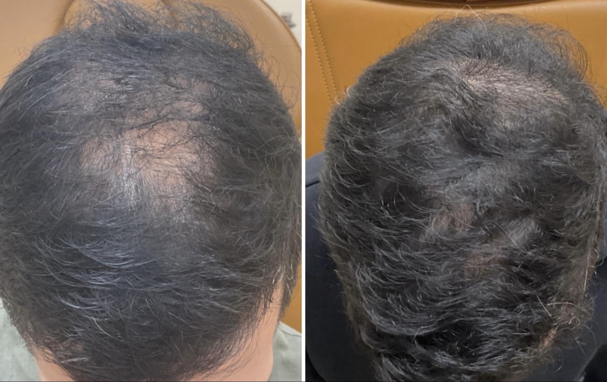 Before and after hair loss treatment on the crown in Newport Beach, CA