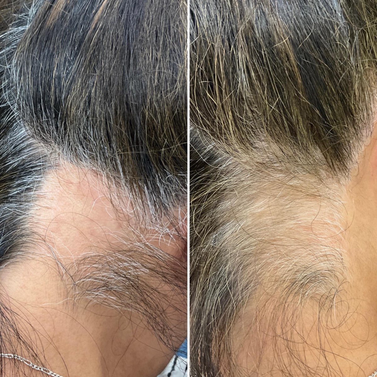 Before and after hair regrowth along the hairline in Newport Beach, CA
