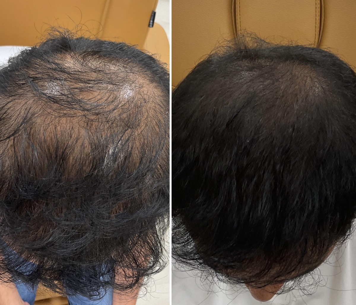 Before and after hair loss treatment on the top of the scalp in Newport Beach, CA