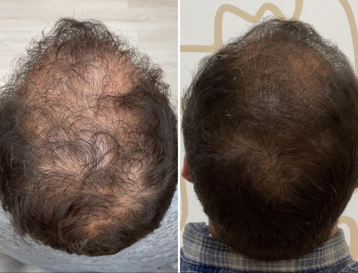 Before and after thinning hair treatment on the crown in Newport Beach, CA