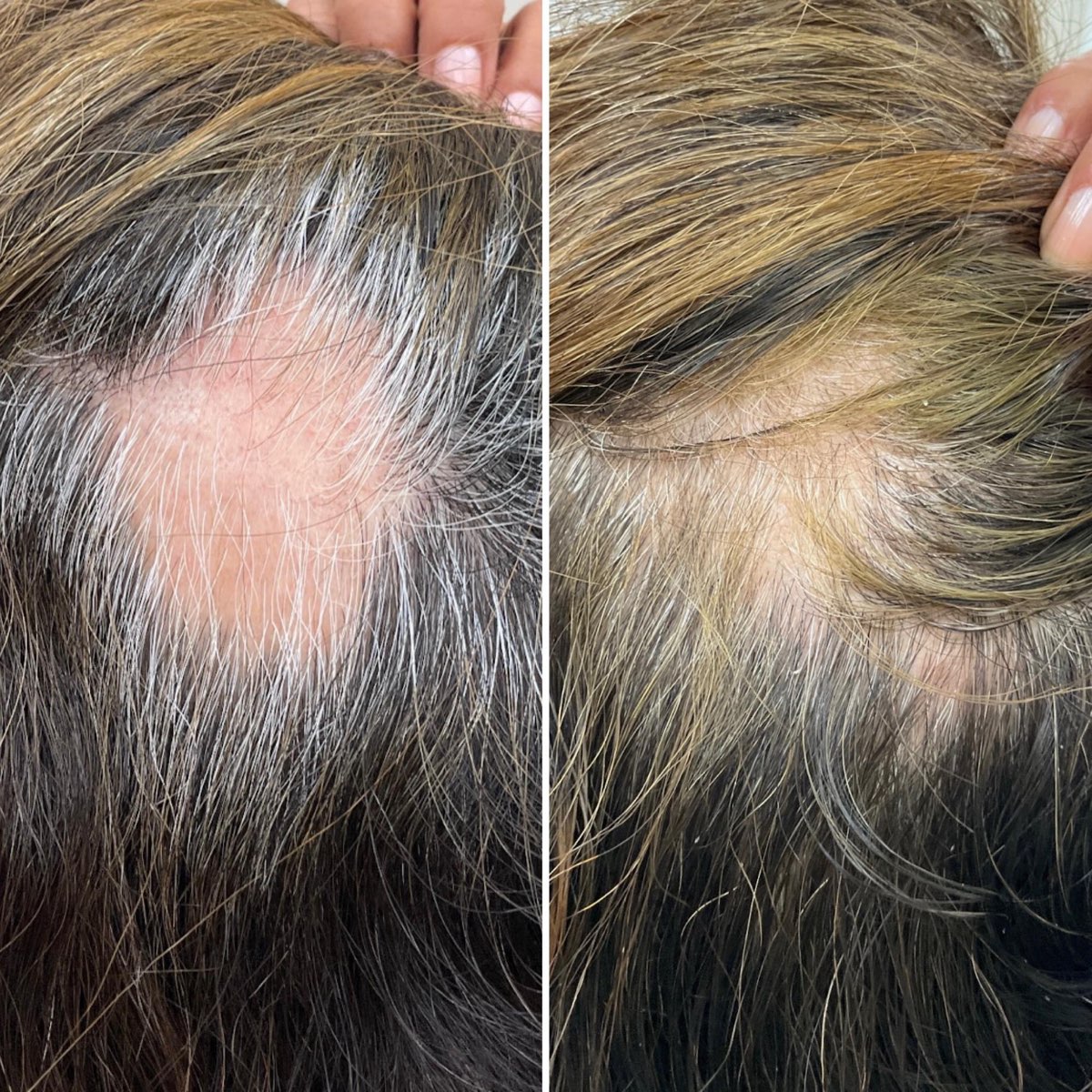 Before and after alopecia areata treatment on the scalp in Newport Beach, CA