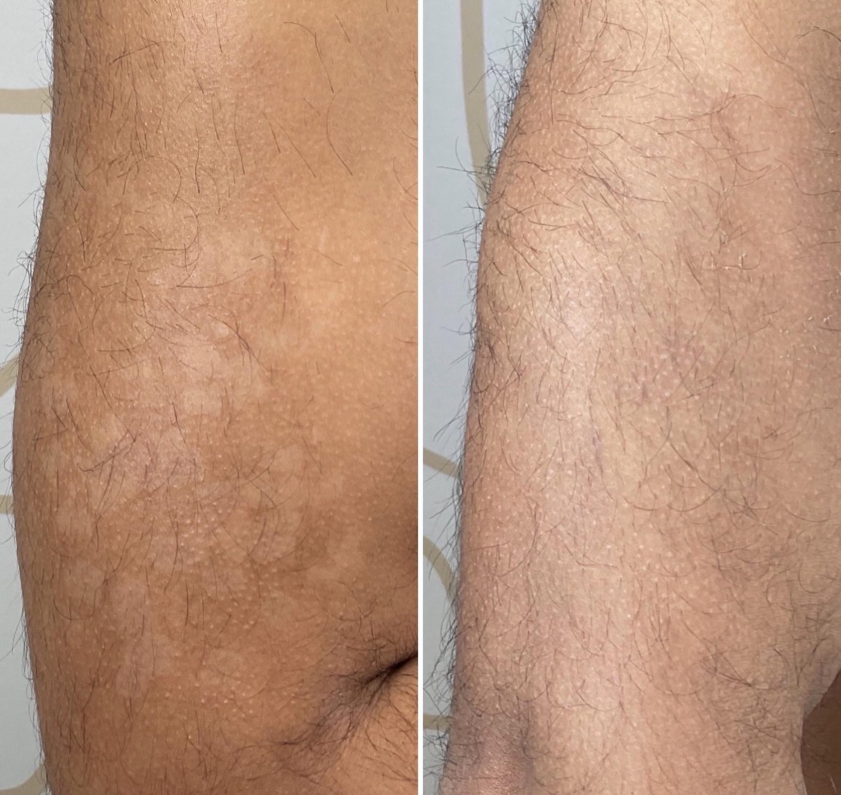 Before and after hyperpigmentation treatment on the arm in Newport Beach, CA