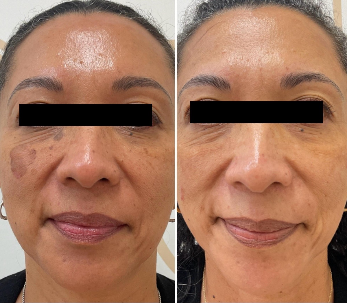 Before and after treatment of a dark patch on the cheek in Newport Beach, CA