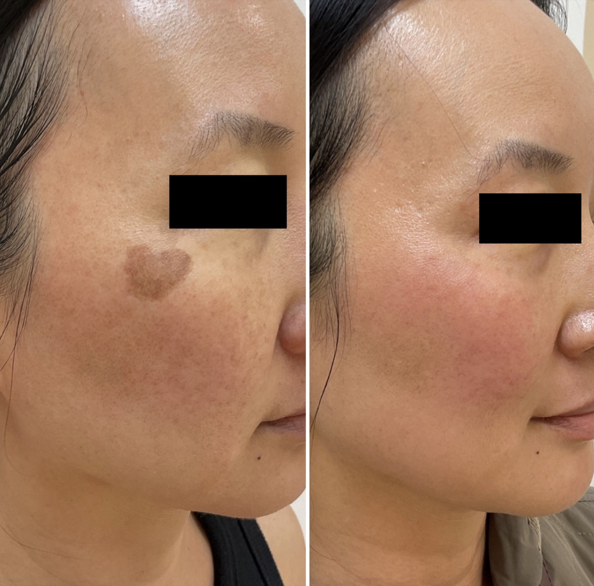 Before and after treatment of a pigmented patch on the cheek in Newport Beach, CA
