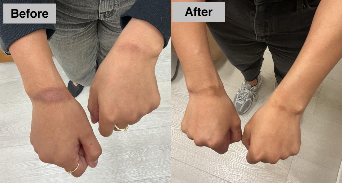 Before and after hyperpigmentation treatment on the wrists in Newport Beach, CA