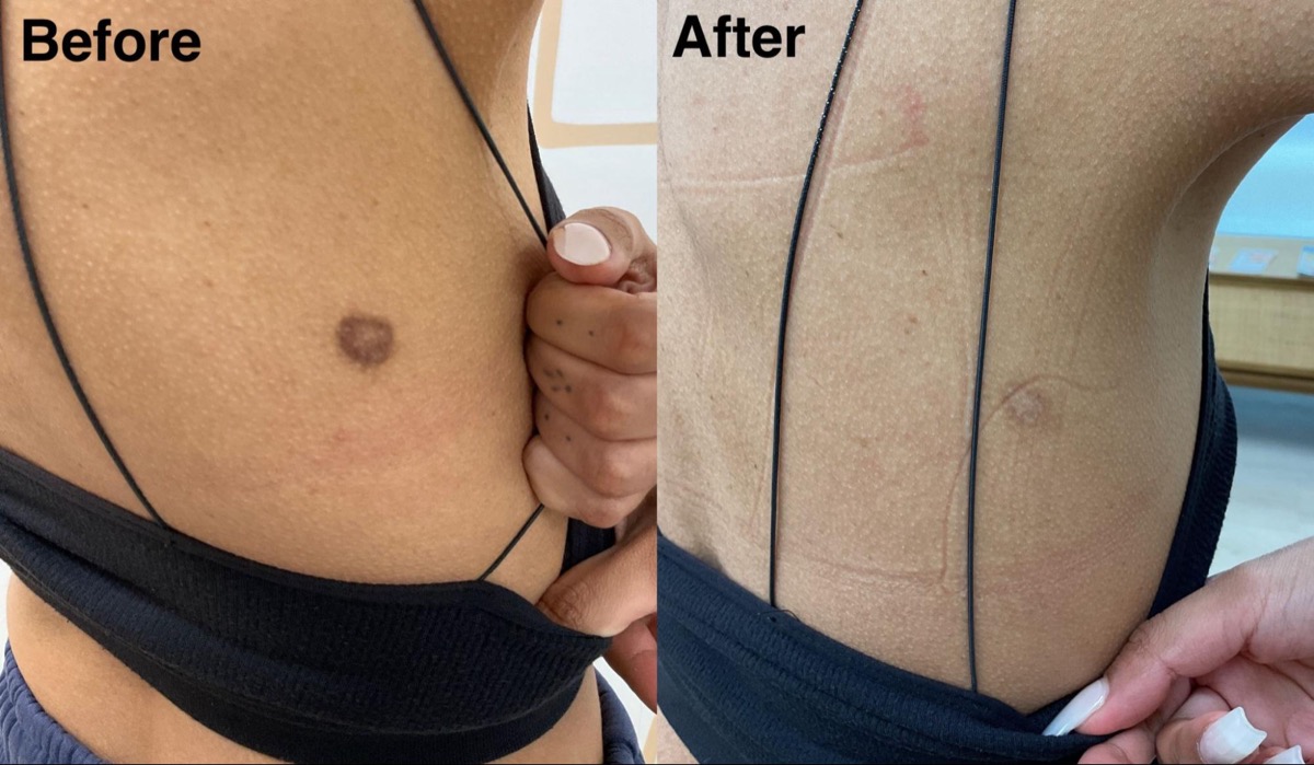 Before and after treatment of a dark spot on the torso in Newport Beach, CA