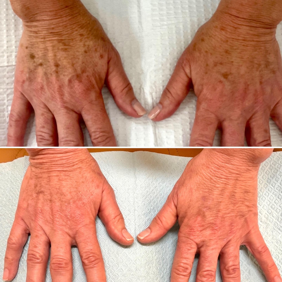 Before and after hyperpigmentation treatment on the hands in Newport Beach, CA