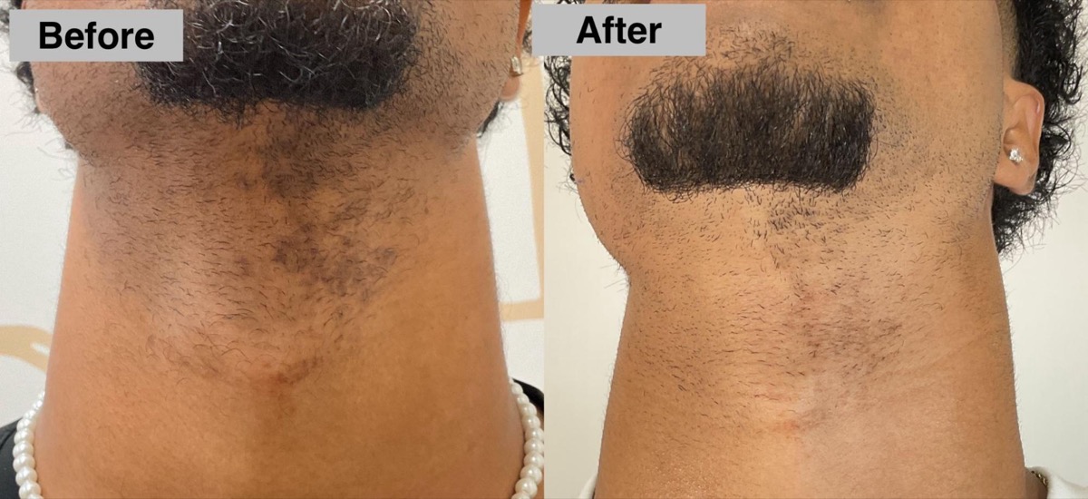 Before and after hyperpigmentation treatment on the neck in Newport Beach, CA