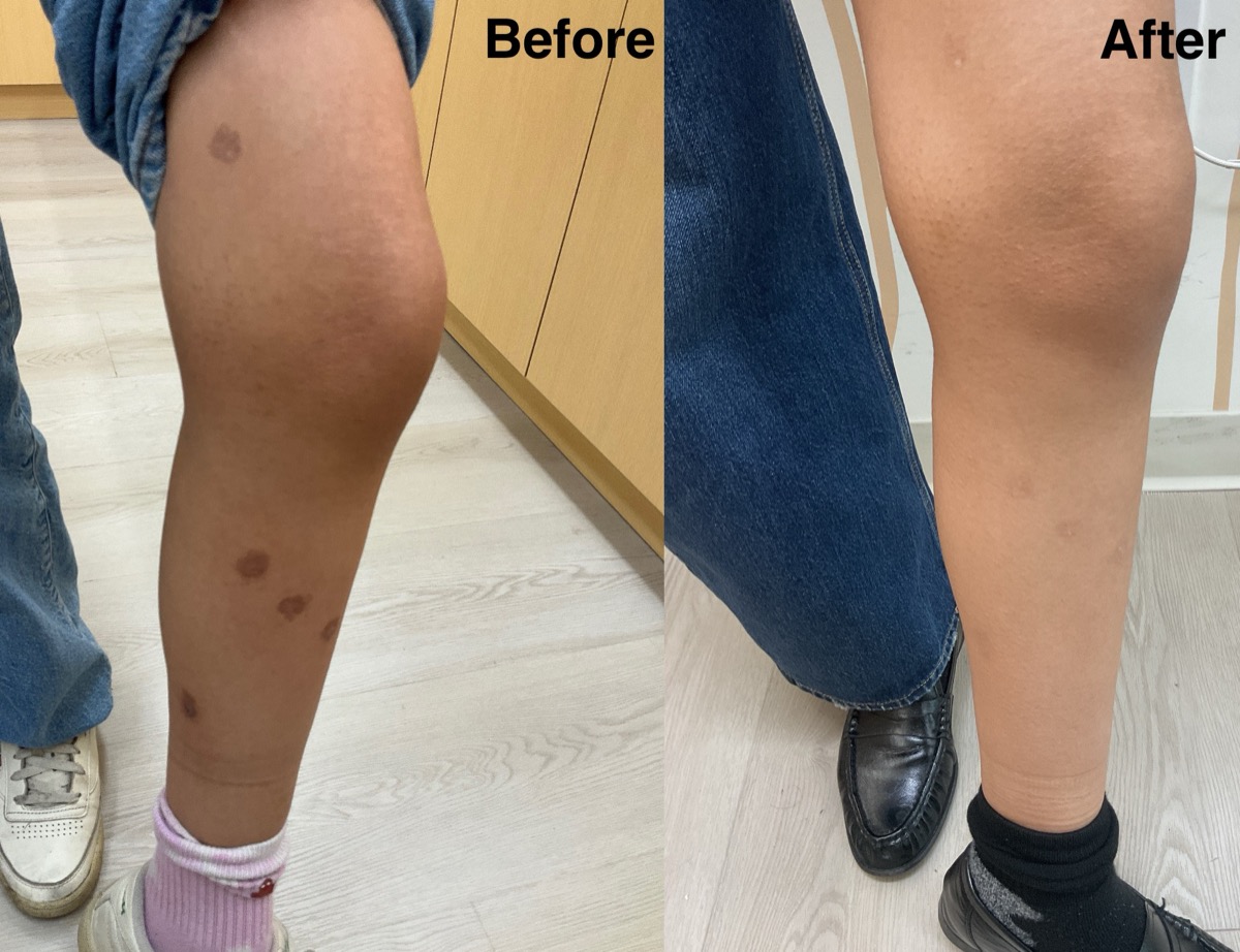 Before and after treatment of dark spots on the legs in Newport Beach, CA