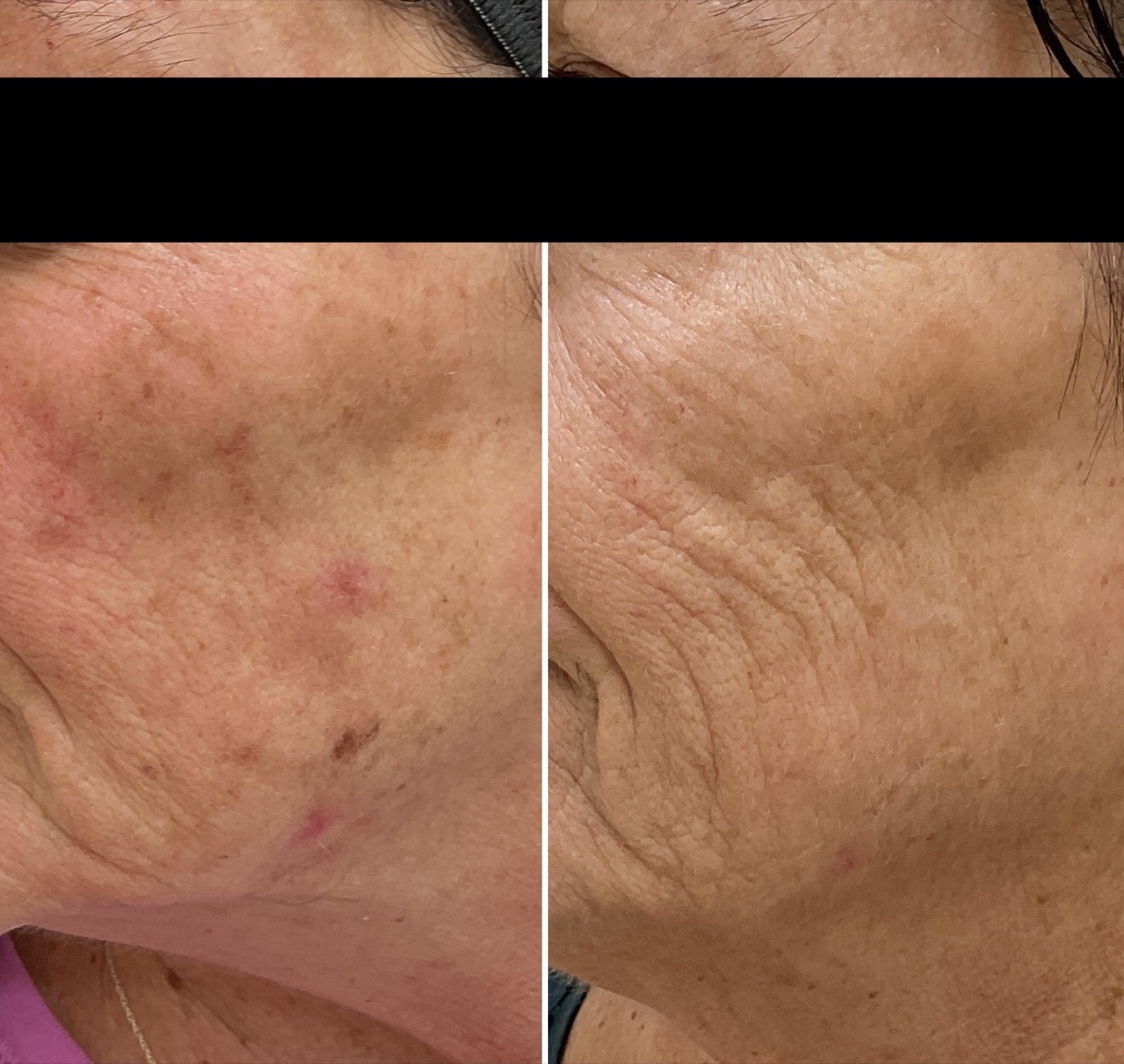 Before and after hyperpigmentation treatment on the cheek and jawline in Newport Beach, CA