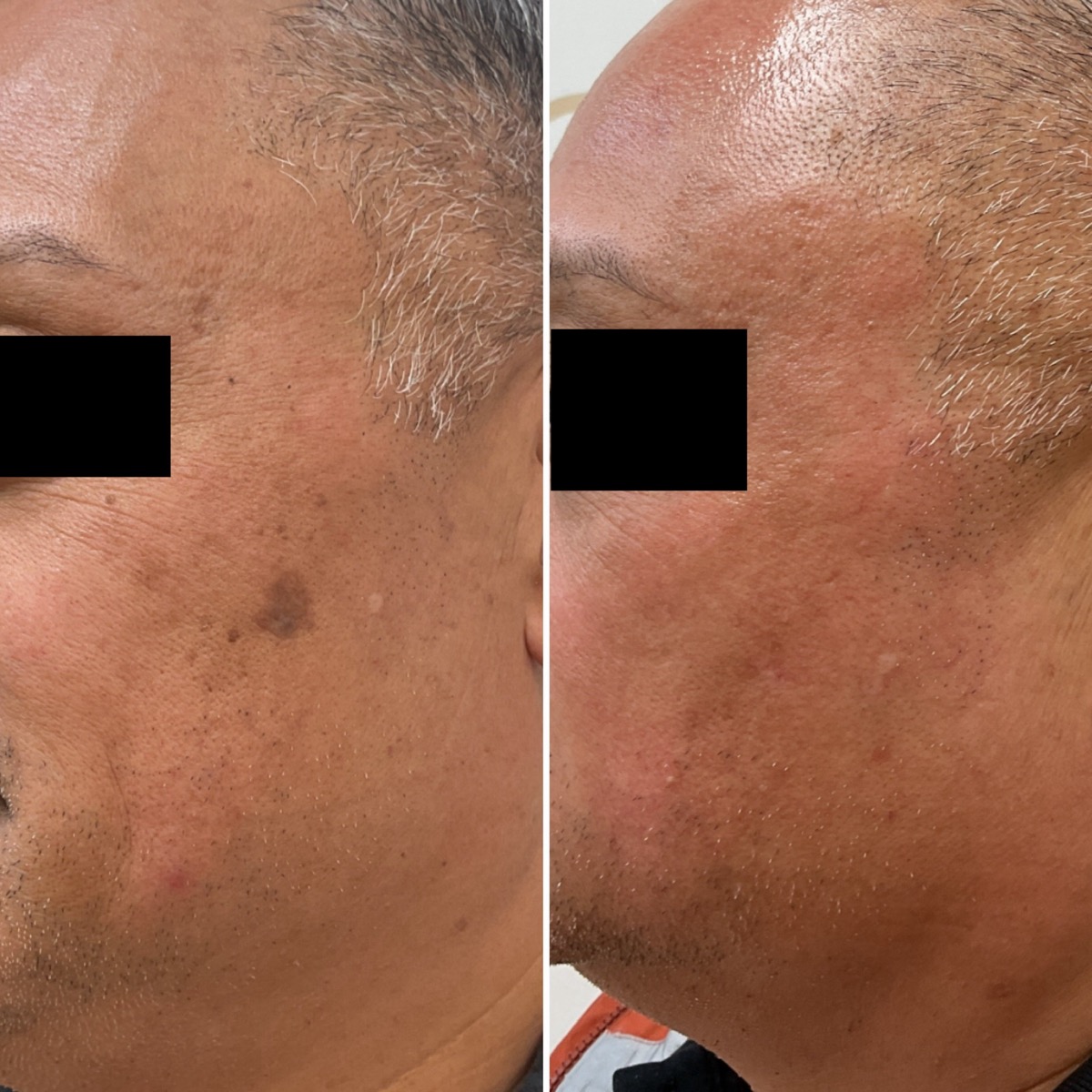 Before and after treatment of a dark spot on the temple in Newport Beach, CA