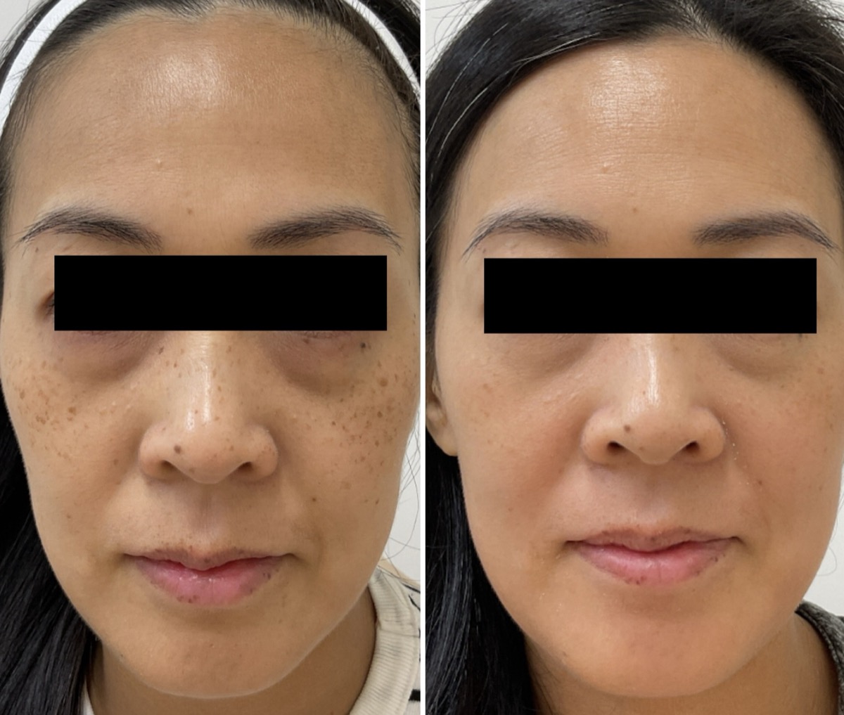 Before and after hyperpigmentation treatment on the cheeks in Newport Beach, CA