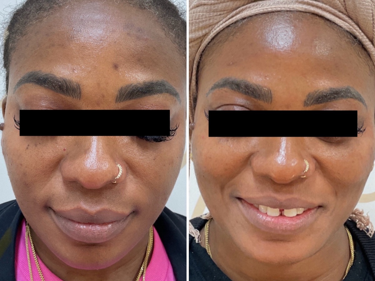 Before and after hyperpigmentation treatment on the forehead and cheeks in Newport Beach, CA