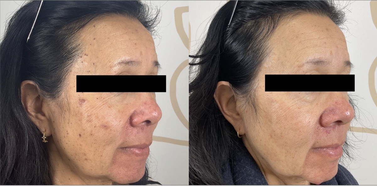 Before and after hyperpigmentation treatment on the side of the face in Newport Beach, CA