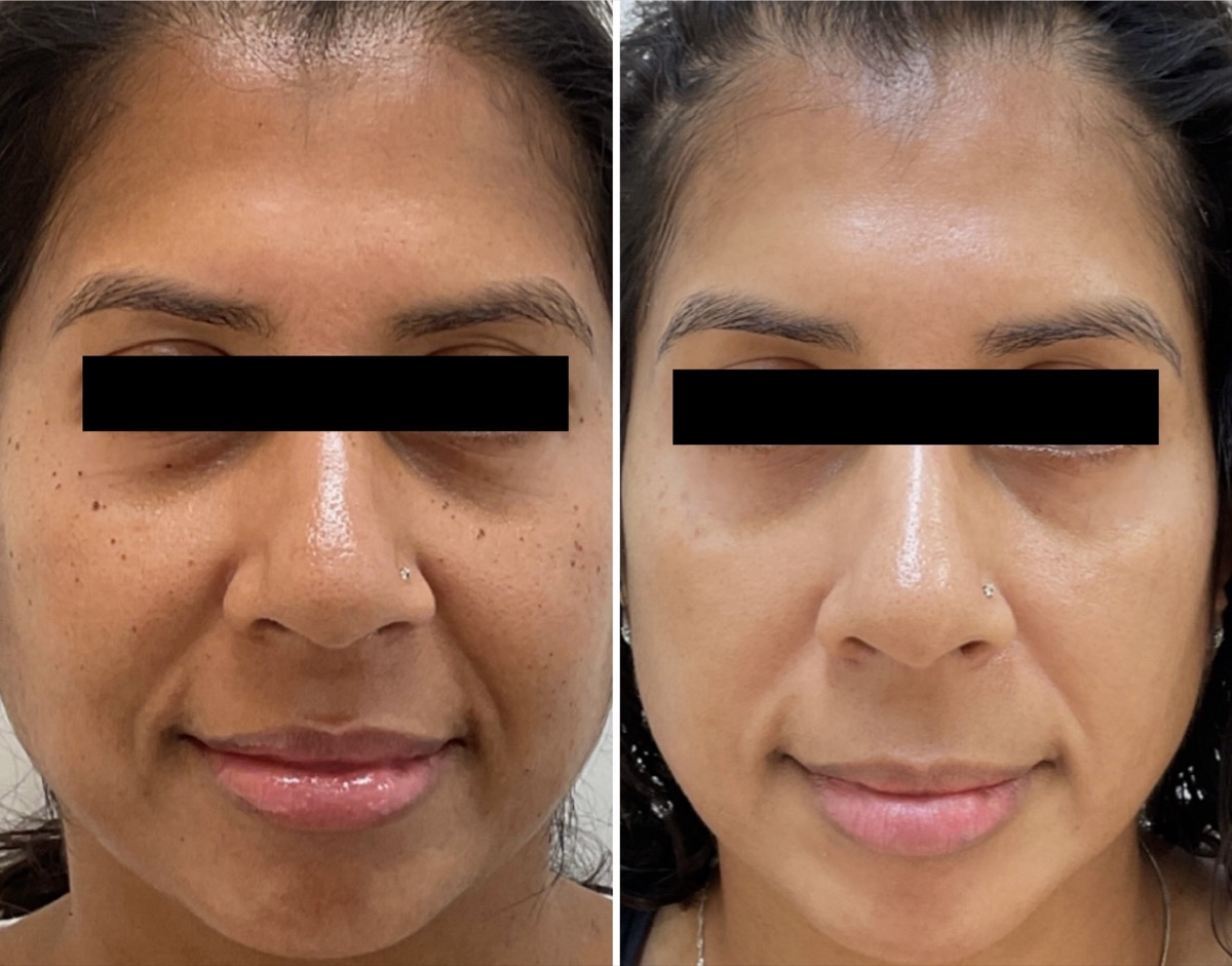 Before and after facial dark spot treatment in Newport Beach, CA
