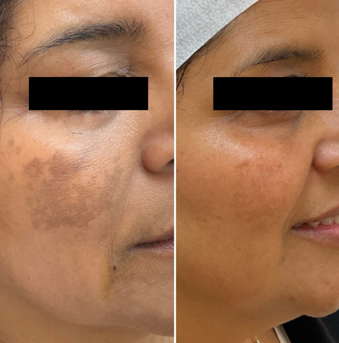 Before and after melasma treatment on the cheek in Newport Beach, CA