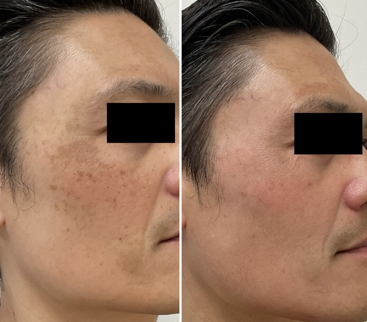 Before and after melasma treatment on the upper cheek in Newport Beach, CA