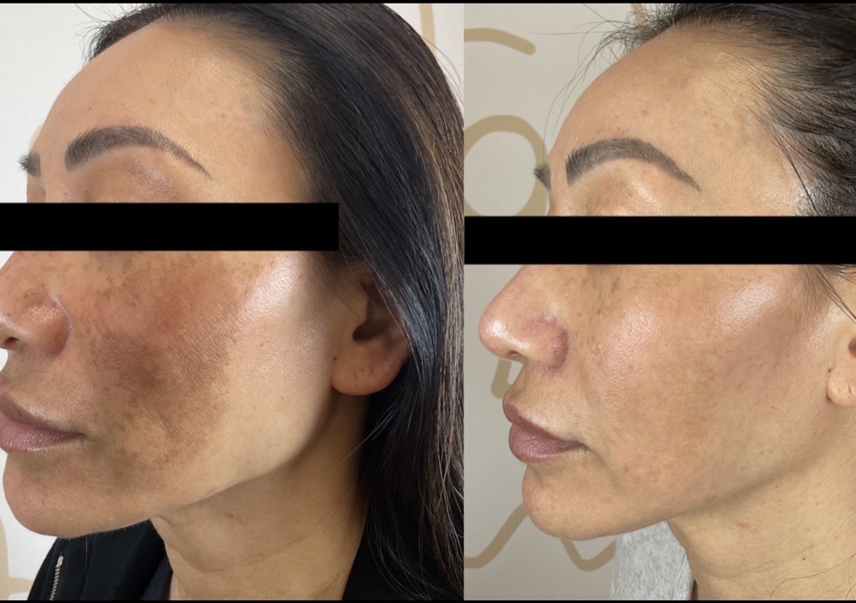 Before and after melasma treatment on the cheek and temple in Newport Beach, CA