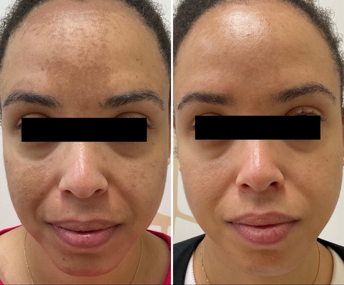 Before and after melasma treatment on the forehead and cheeks in Newport Beach, CA