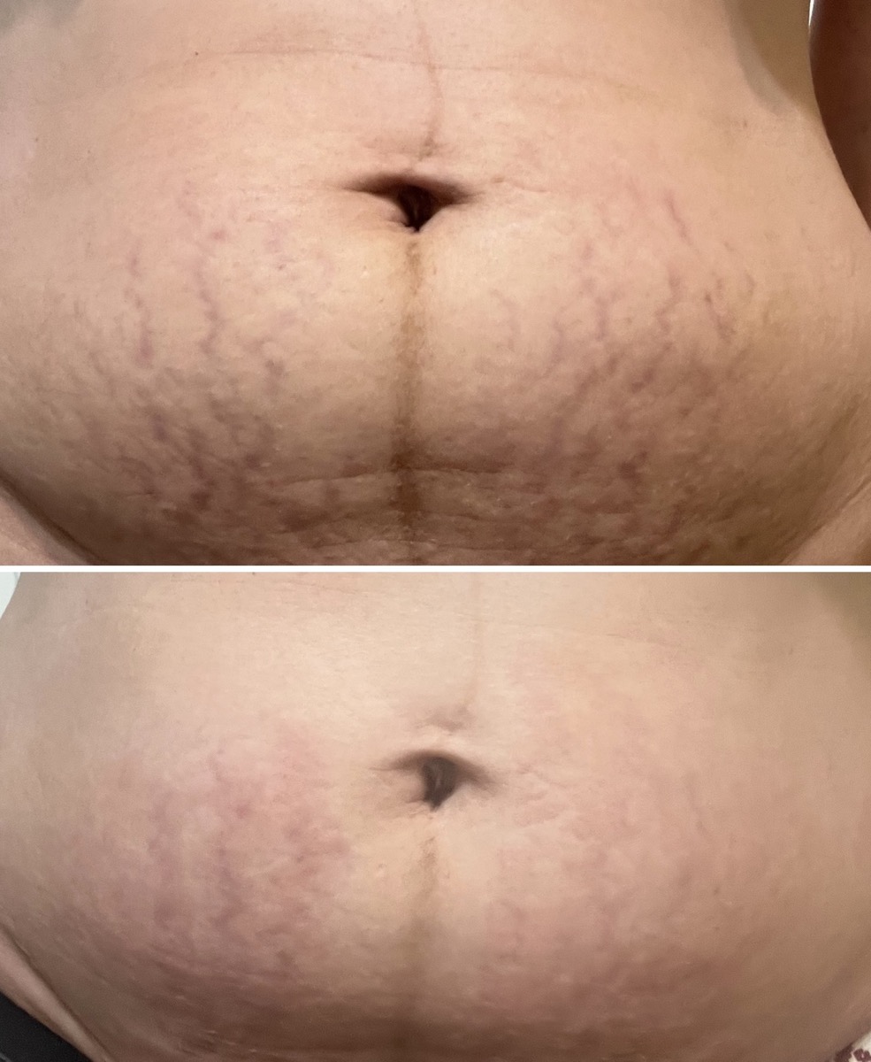 Before and after postpartum stretch mark treatment on the abdomen in Newport Beach, CA