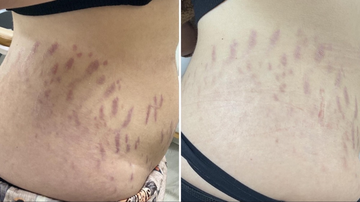 Before and after stretch mark treatment on the hip in Newport Beach, CA
