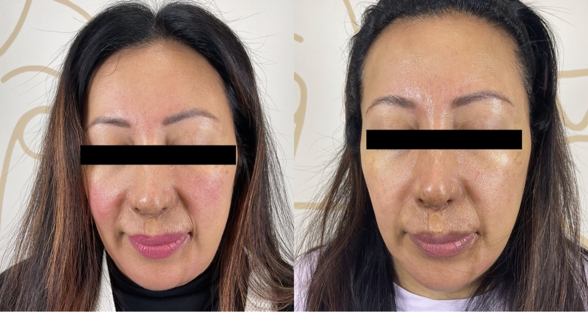 Before and after rosacea treatment in Newport Beach, CA