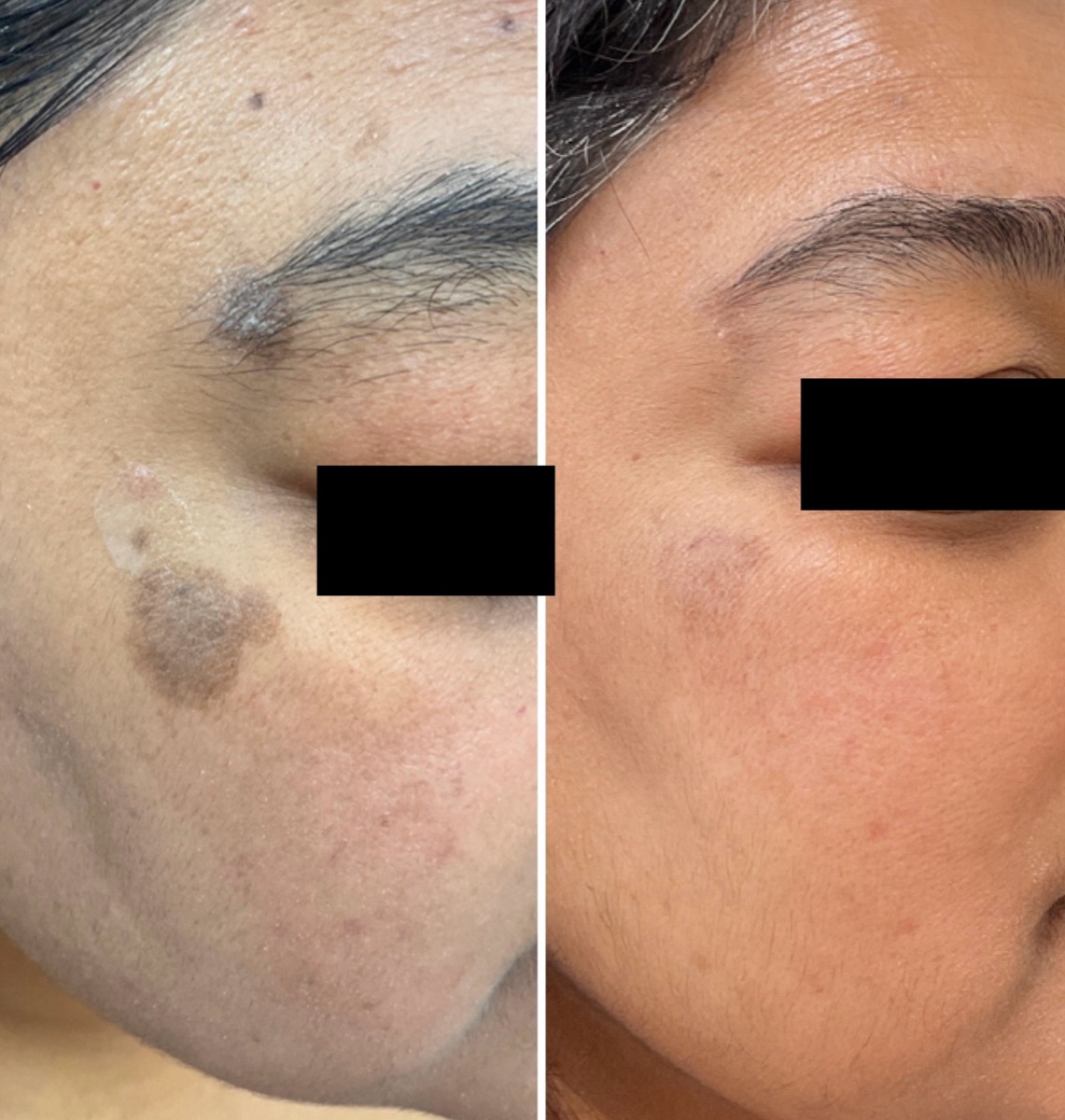 Before and after sun spot treatment on the temple in Newport Beach, CA