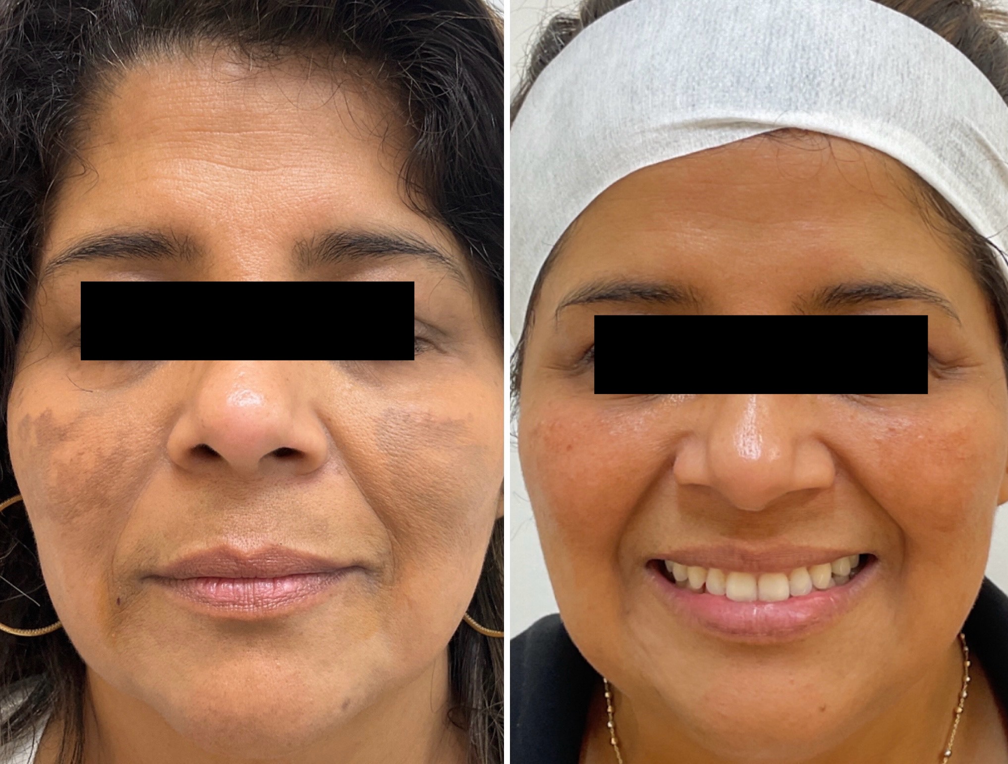 Treatment of melasma with the Picosure Pro laser