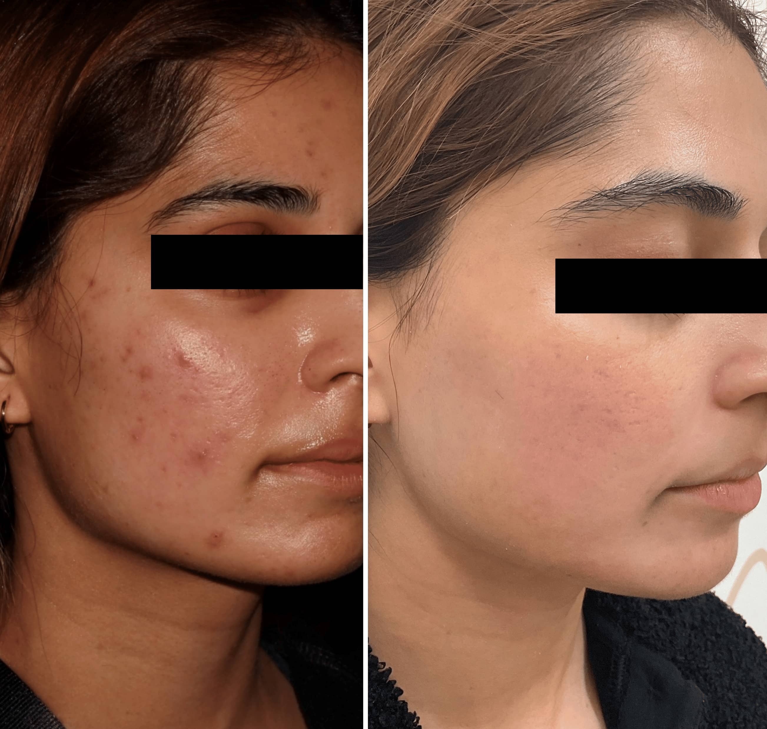 Treatment of acne and acne scars using medications and laser treatment