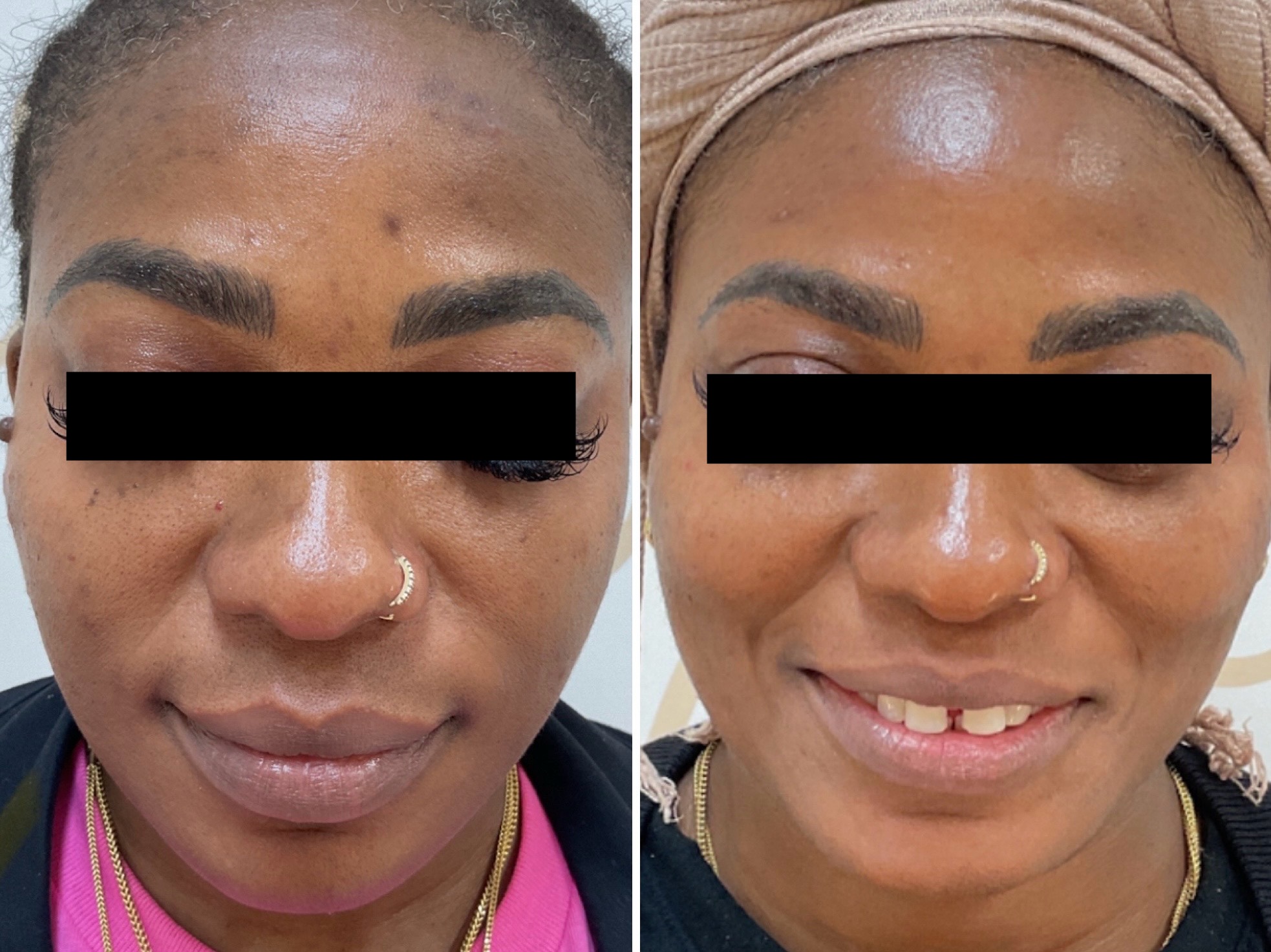 Treatment of hyperpigmentation using the Picosure Pro laser