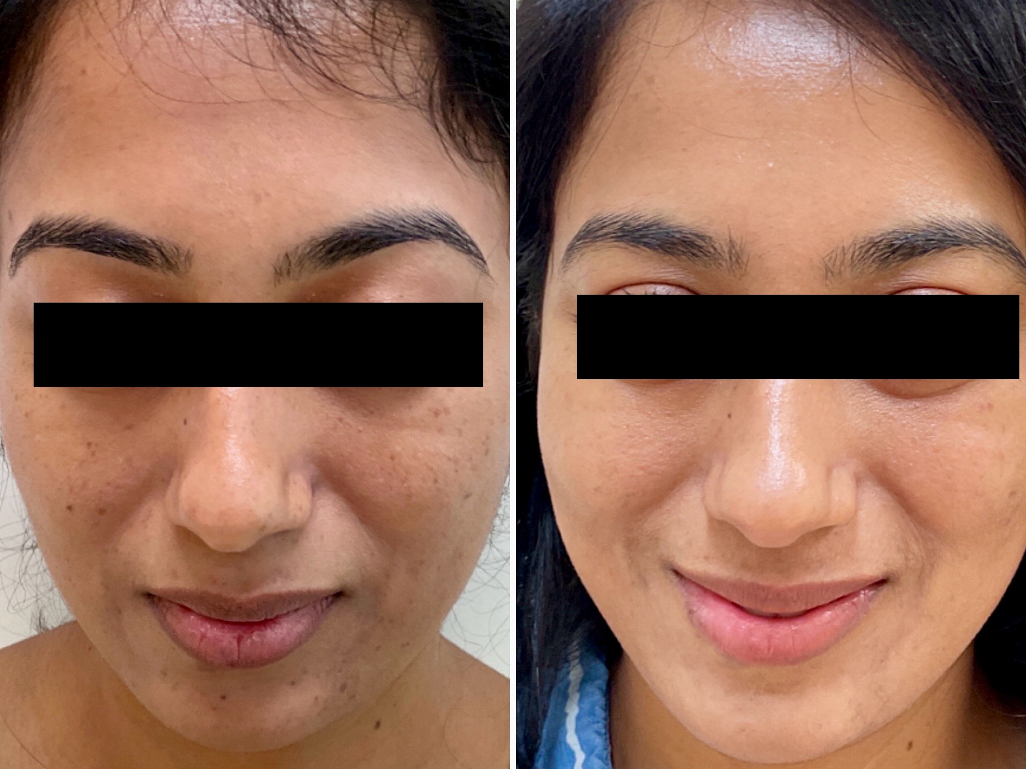 Treatment of hyperpigmentation using the Picosure Pro laser