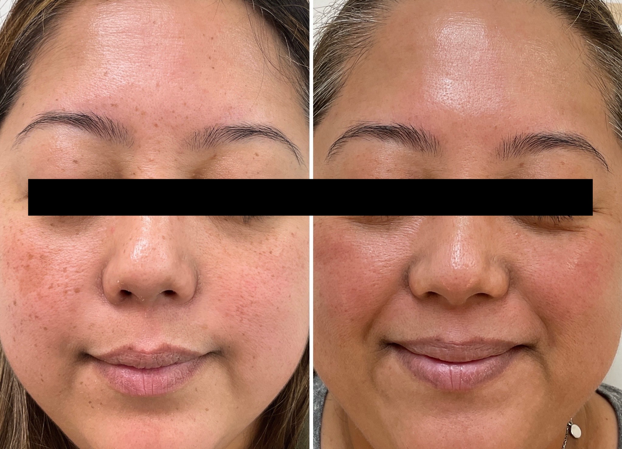 Treatment of hyperpigmentation using the Picosure Pro laser