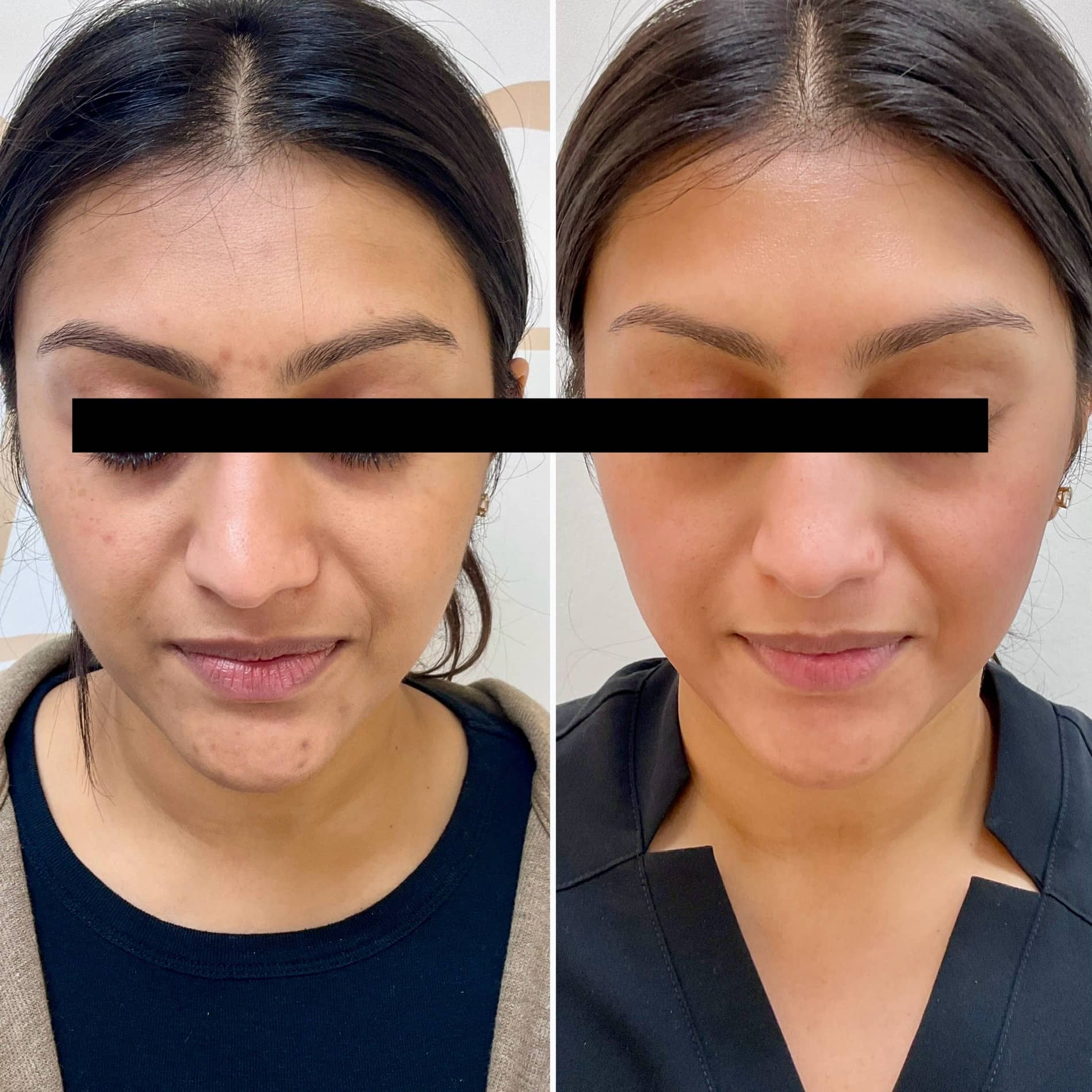 Treatment of hyperpigmentation using the Picosure Pro laser