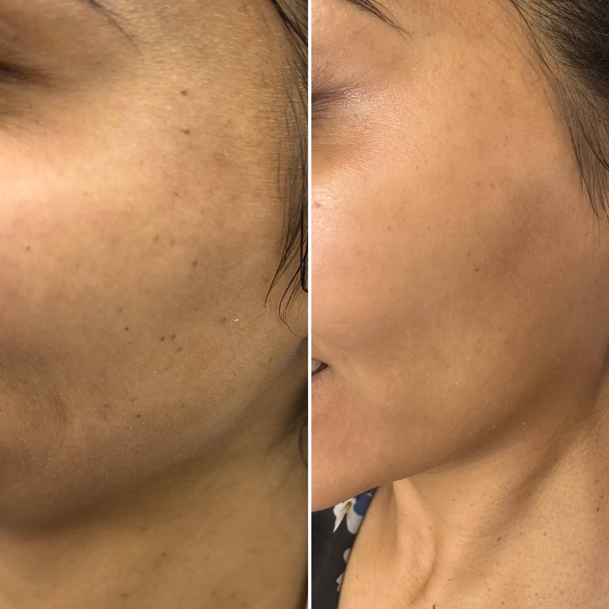 Treatment of brown bumps on the face