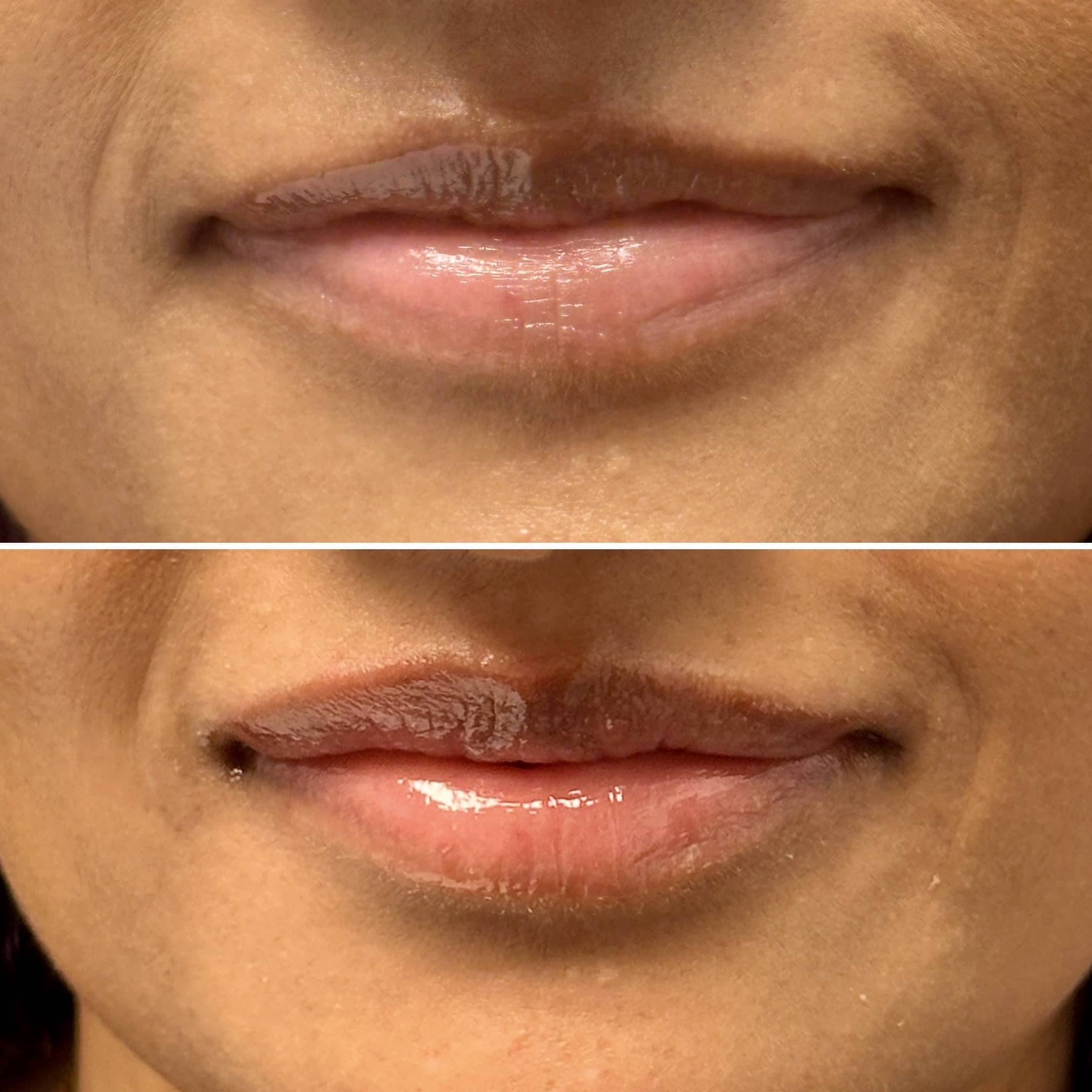 Liplase treatment for plump healthy lips using laser