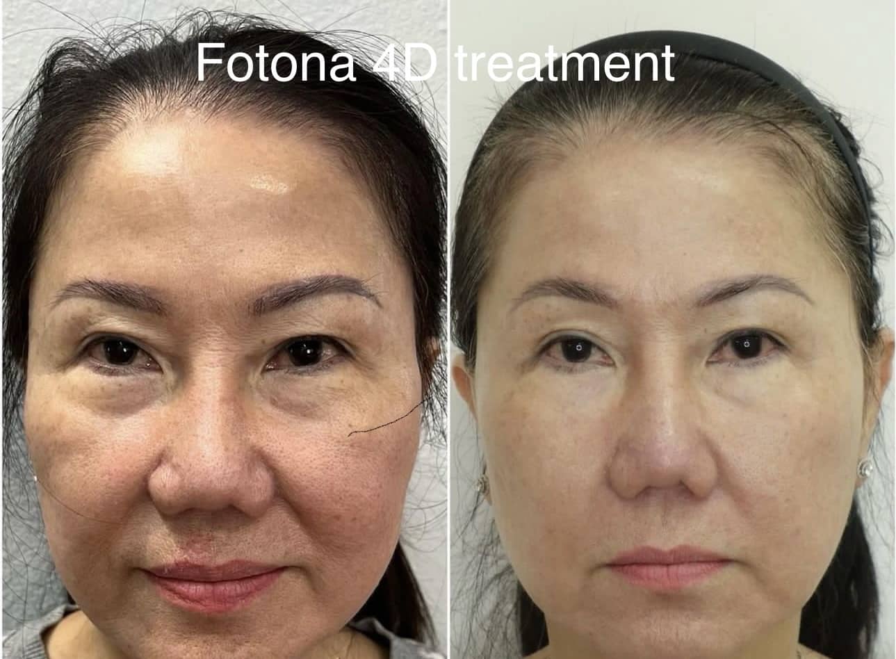 Fotona 4D treatment for non invasive facial lift and skin tightening using laser