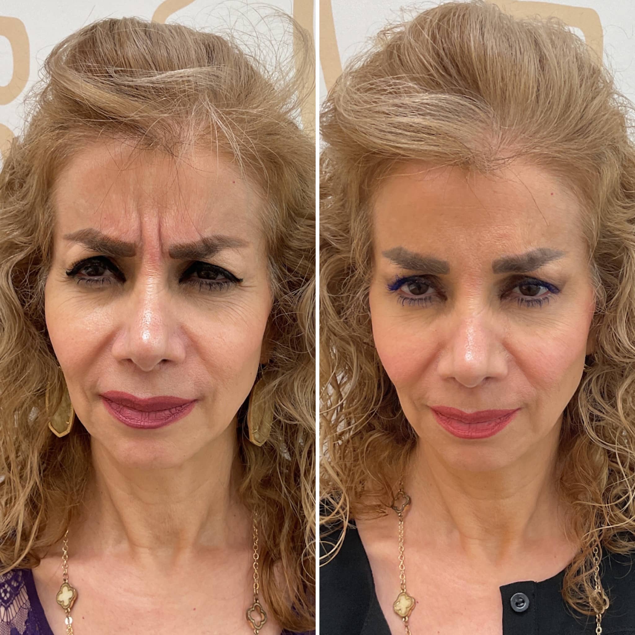 Treatment of wrinkles on the glabella using botulinum toxin