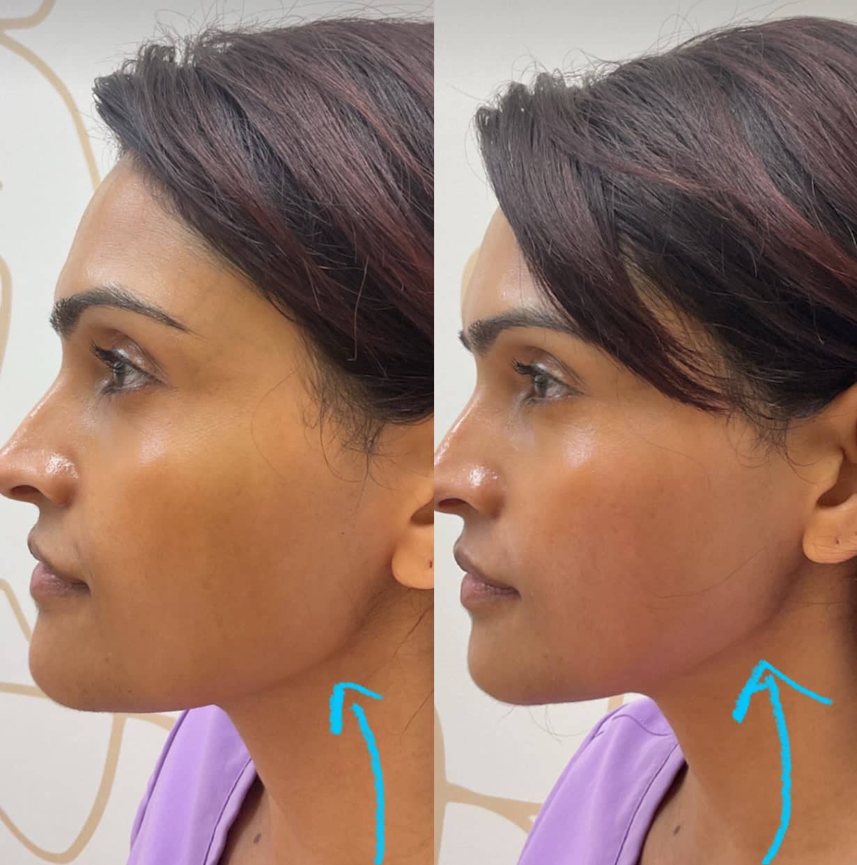 Skin tightening before and after