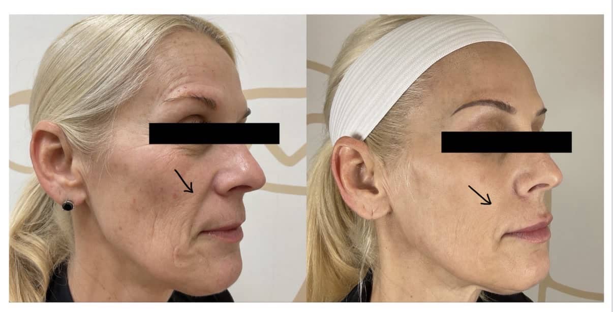 Skin tightening before and after