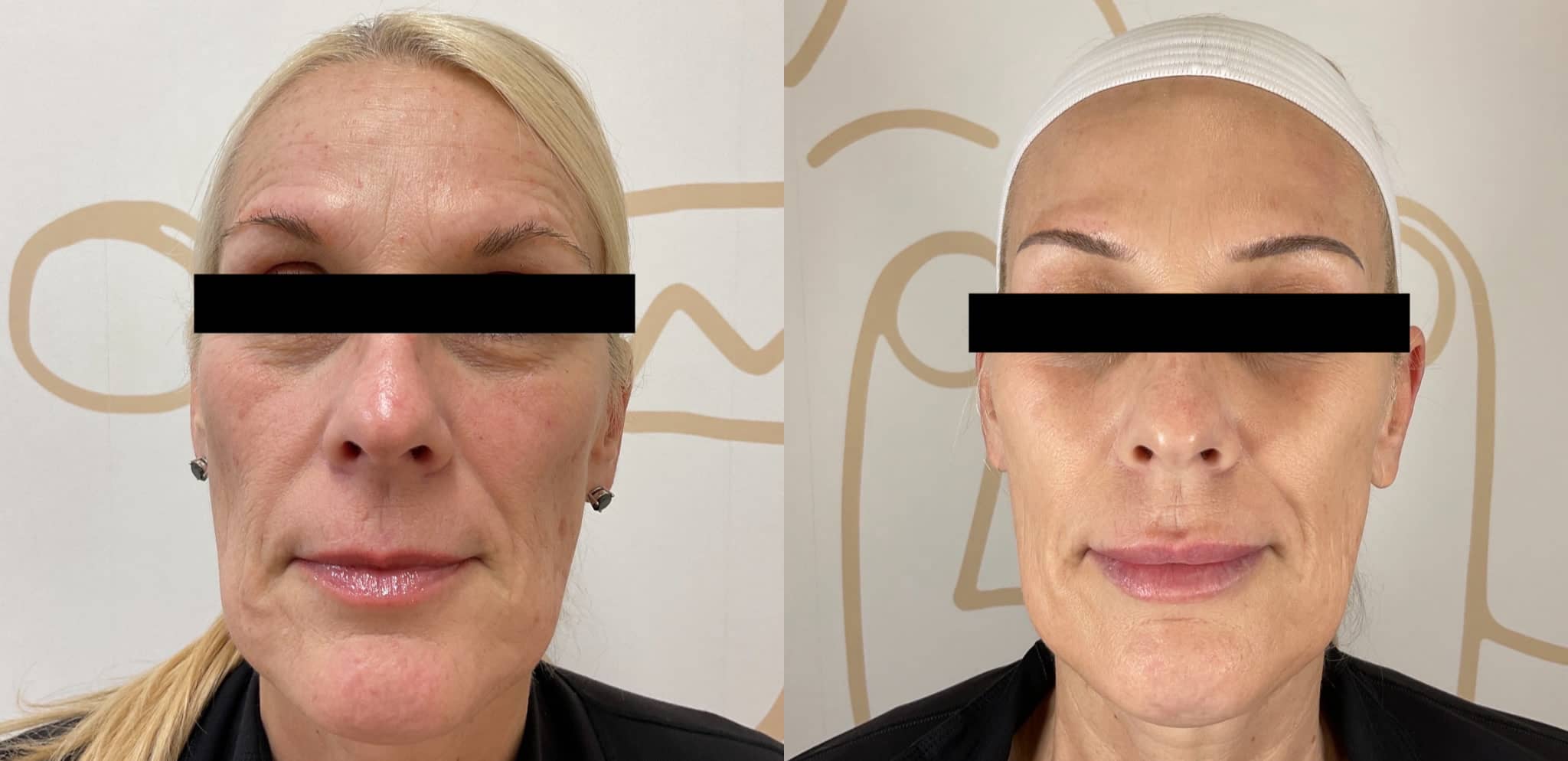 Skin tightening before and after