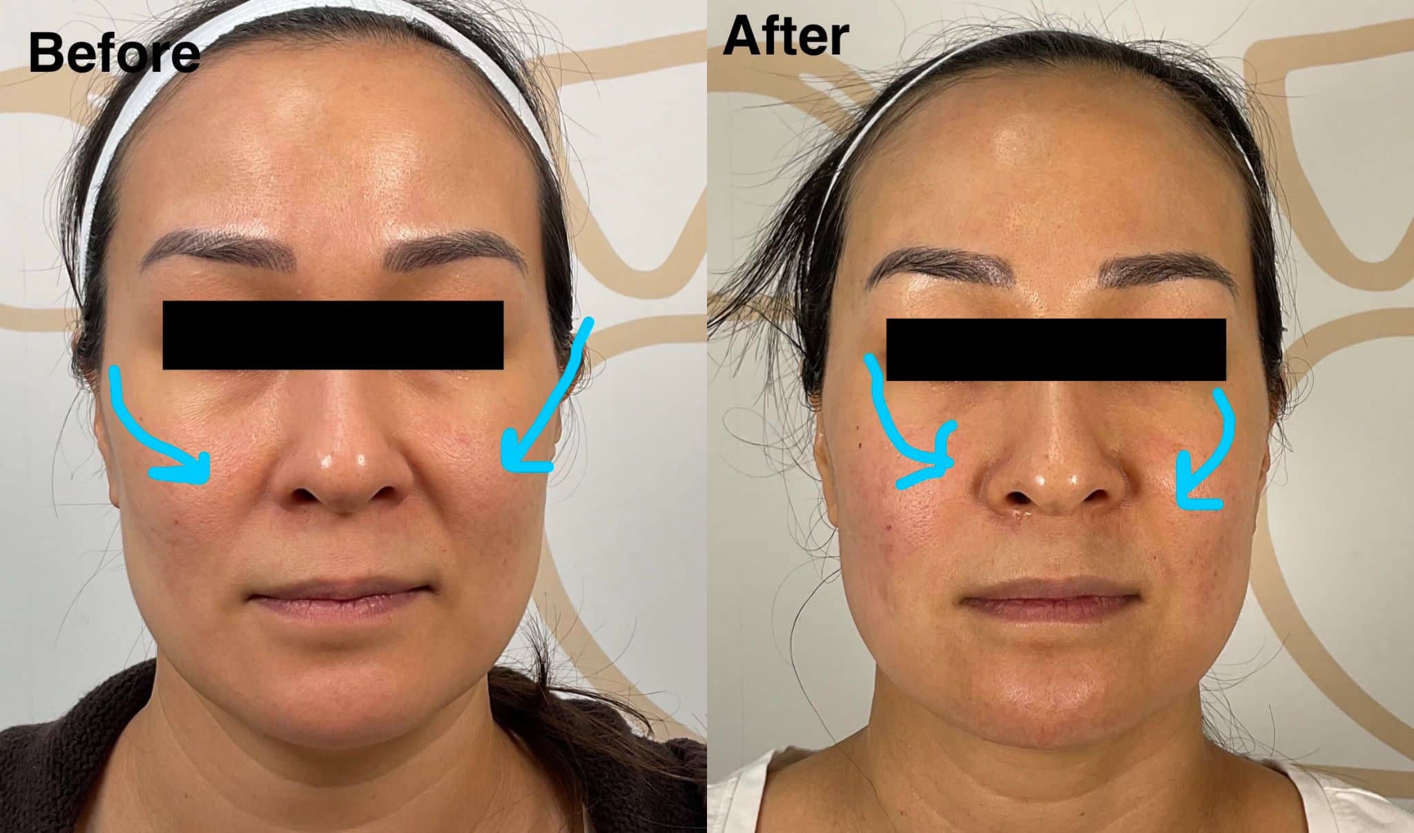 Skin tightening before and after