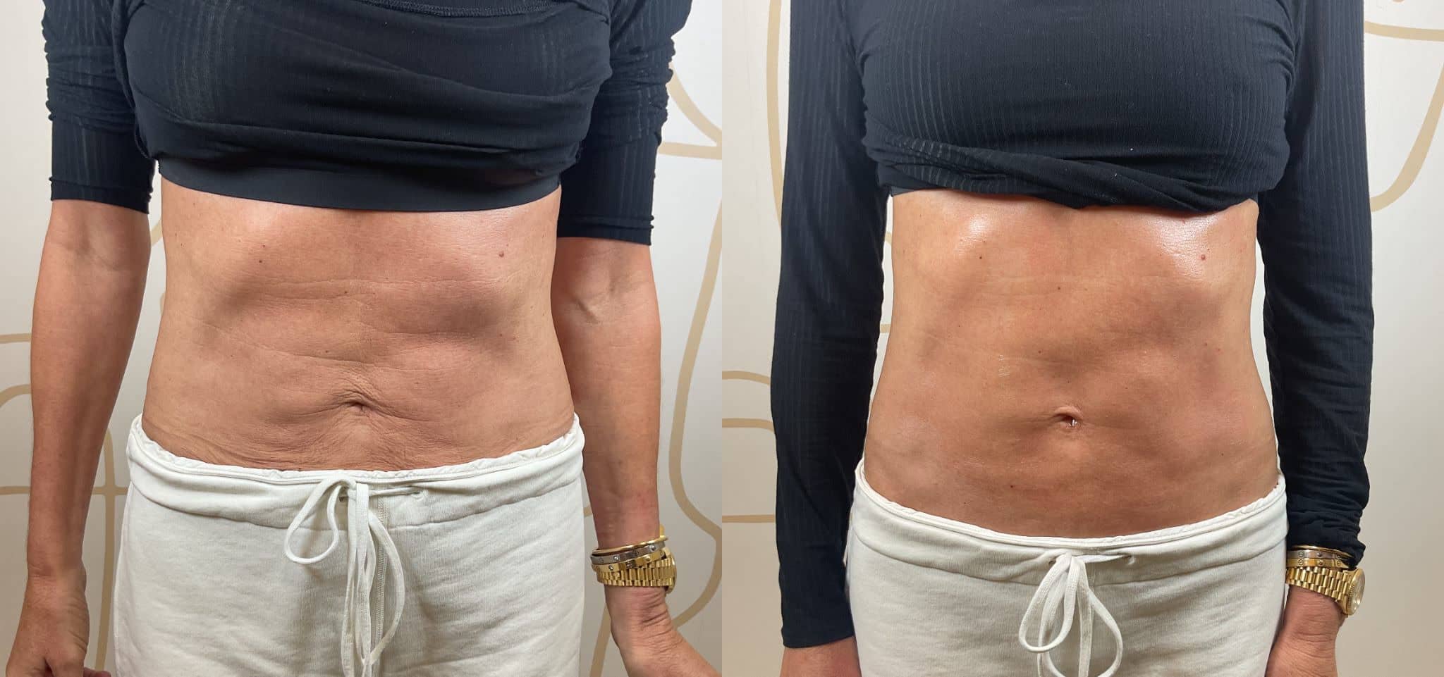 Skin tightening before and after