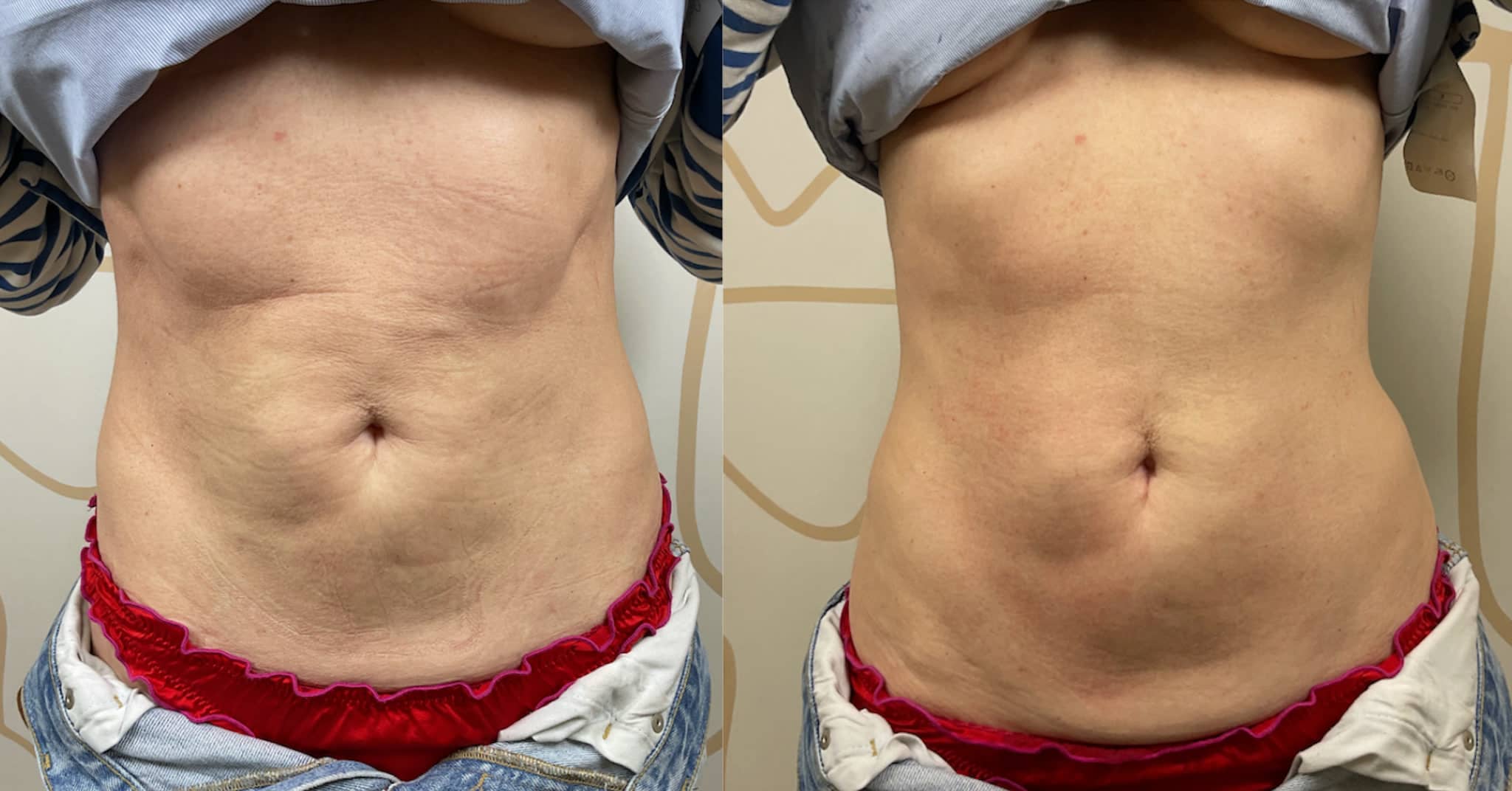 Skin tightening before and after
